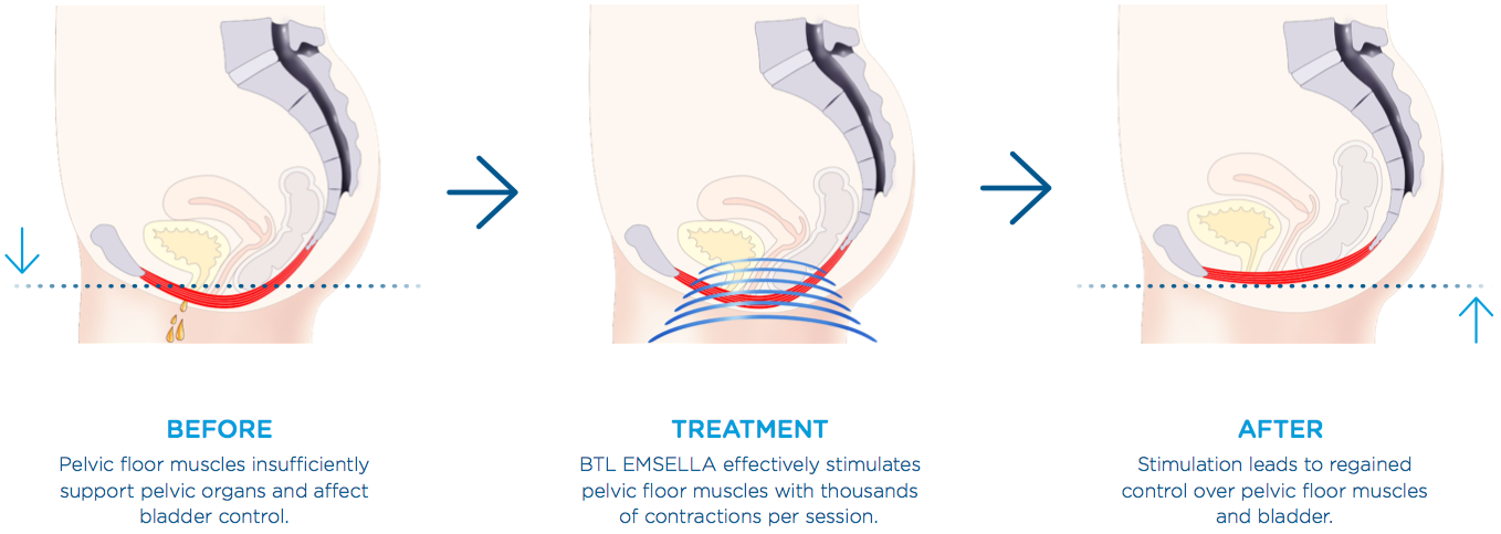 BTL_Emsella_Incontinence